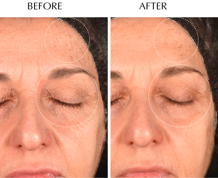 Before and after using Y-3, forehead area
